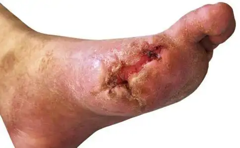 202例糖尿病足溃疡患者临床特征及生存预后影响因素分析