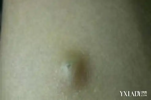 【图】怎么消除脂肪瘤 为你分析一些治疗偏方