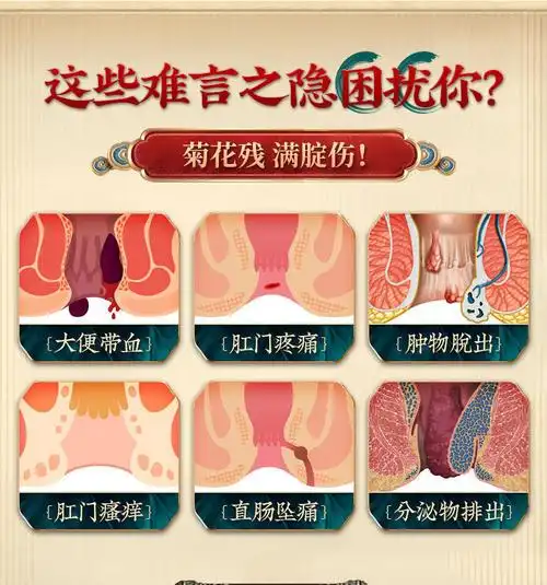 灵南京同仁堂膏外痔混合痔内痔肛门瘙痒膏无痛三盒装适合较重度