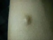 治疗纤维瘤或脂肪瘤怎么治疗