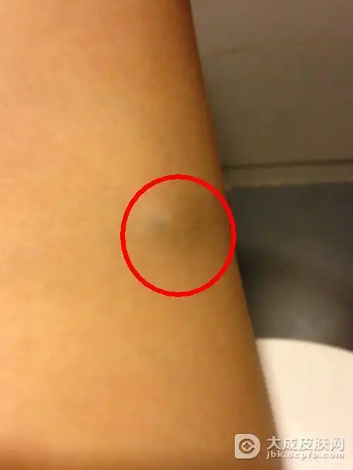 脂肪瘤怎么治疗比较好呢